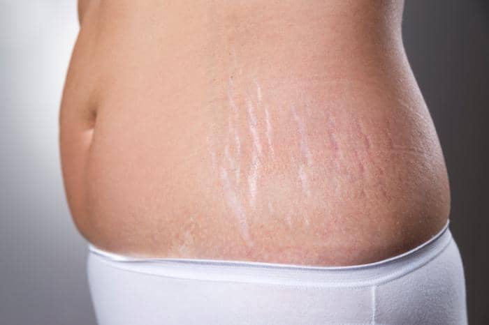 استرچ مارک روی شکم ، نیاسینامید ، علائم کشش