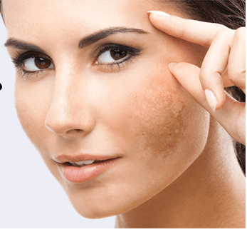 درمان لک های ملاسما ، پیشگیری و جلوگیری از تشکیل لک های پوستی ملاسما