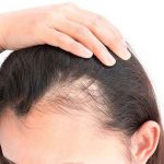 چگونه از ریزش مو جلوگیری کنیم ؟ روش های پیشگیری و درمان ریزش مو