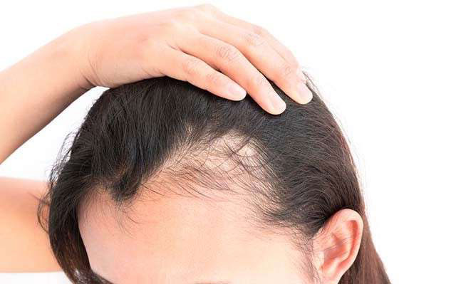 چگونه از ریزش مو جلوگیری کنیم ؟ درمان ریزش مو ، روش های پیشگیری از ریزش مو