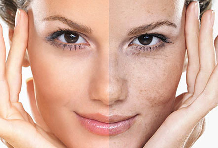 درمان لک های پوستی به صورت علمی و خانگی ، بررسی علت تشکیل یا ایجاد لک صورت