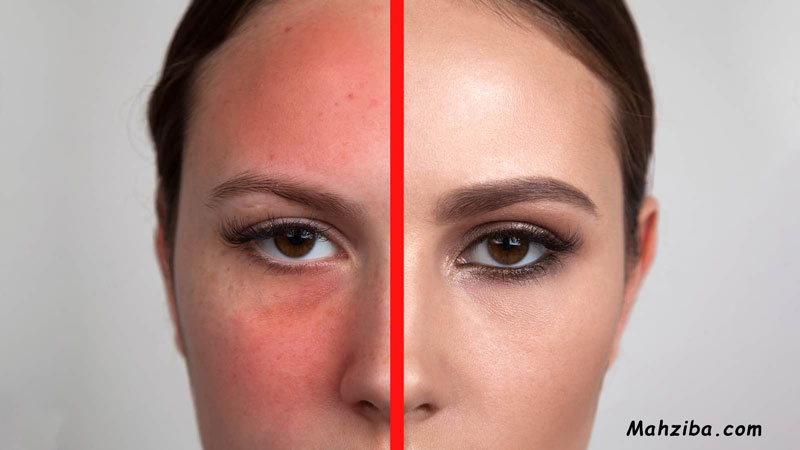 قرمز شدن پوست در اثر آسیب نور خورشید
