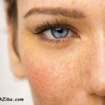 چگونه لک صورت را از بین ببریم ؟ بررسی 8 روش علمی درمان لک های پوستی