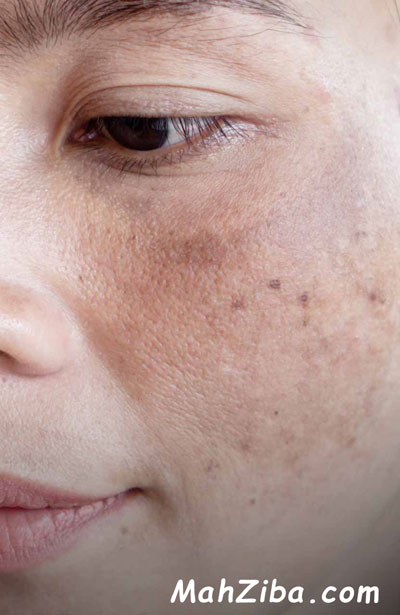 خواص و فواید ویتامین سی برای لک صورت و پوست