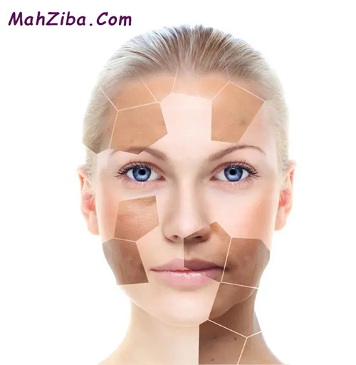 درمان لک صورت با 14 روش علمی و ثابت شده و موثر